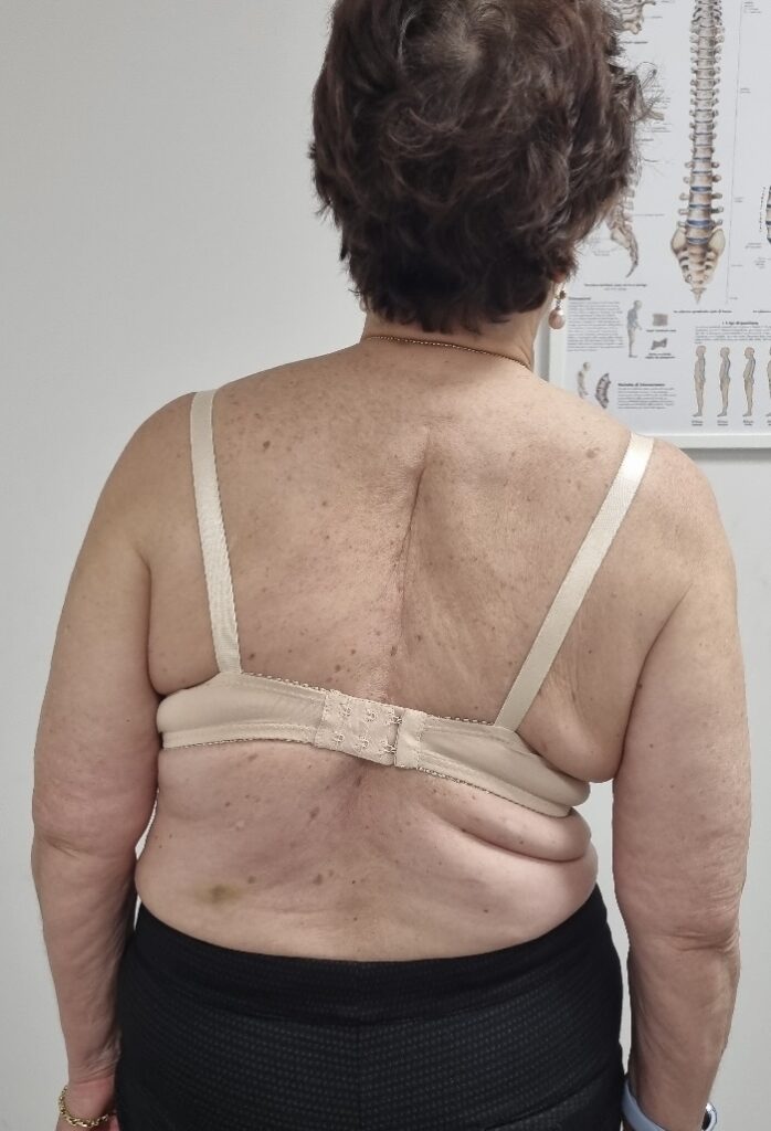 Scoliosi negli Adulti: Perché Può Comparire e Come Gestirla Senza Chirurgia 1 Scoliosi negli Adulti: Perché Può Comparire e Come Gestirla Senza Chirurgia